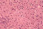 Figure 1. Photomicrograph of a section of the cerebral cortex from horse with Eastern equine encephalomyelitis virus infection. Note the dense neutrophilic response, vascular damage, and fibrin thrombi. Hematoxylin and eosine stain. 