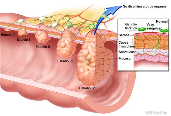 Estadificación del cáncer del colon; muestra penetración del tumor a través de las capas del colon con cáncer en estadios 0, I, II, III y IV. El recuadro interior muestra serosa, músculos, submucosa y las capas de mucosa de la pared del colon, ganglios linfáticos y vasos linfáticos.