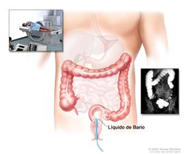 Procedimiento con enema de bario; muestra la inserción del líquido de bario en el recto que fluye hasta el colon. El recuadro interior muestra la imagen de un paciente en camilla al que se le administra una enema de bario.