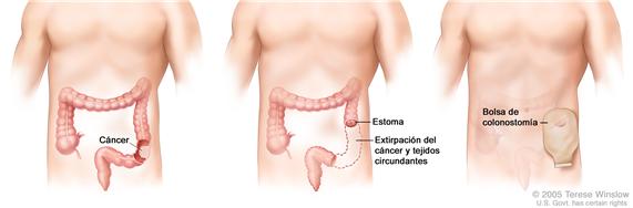 La ilustración a tres paneles muestra cirugía del cáncer de colon con colostomía; el primer panel muestra el área del colon con cáncer, el panel medio muestra la extracción del cáncer y el tejido circundante y la creación del estoma, el último panel muestra la bolsa de colostomía adherida al estoma.