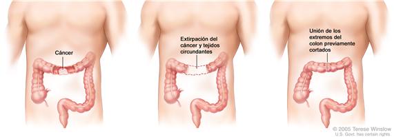 La ilustración a tres paneles muestra cirugía de cáncer del colon con anastomosis; el primer panel muestra el área del colon con cáncer, el panel medio muestra la extracción del cáncer y el tejido circundante,  el último panel muestra la unión de los extremos del colon.