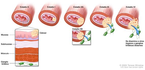 Estadificación del cáncer esofágico; muestra el crecimiento del tumor a través de las capas de la pared esofágica en sus estadios 0, I, II, III y IV. El recuadro muestra el músculo, submucosa y capas mucosas de la pared esofágica y ganglios linfáticos.