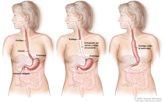 Un dibujo en tres paneles muestra la cirugía del cáncer esofágico; el primer panel muestra el área del esófago con cáncer, el panel del centro muestra la extirpación del cáncer y el tejido circundante, y el último panel muestra como se estira el estómago y se une al resto del esófago.