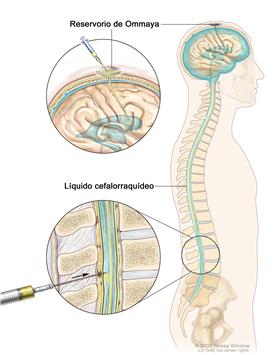 Quimioterapia intratecal; la imagen muestra el líquido cefalorraquídeo (LCR) en el cerebro y la columna vertebral, y un reservorio (depósito) de Ommaya (un aparato en forma de cúpula que se ubica bajo el cuero cabelludo mediante una cirugía; el mismo contiene los medicamentos que circularán a tráves de un tubo delgado hacia el cerebro). La sección superior muestra una jeringuilla con la que se administran medicamentos anticancerosos en el reservorio de Ommaya. La sección inferior muestra una jeringuilla con la que se administran medicamentos anticancerosos directamente en el líquido cefalorraquídeo en la parte inferior de la columna vertebral.