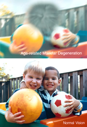 Photo: Two photos of a pair of boys. The images simulate AMD-related vision loss (top photo) and normal vision.
