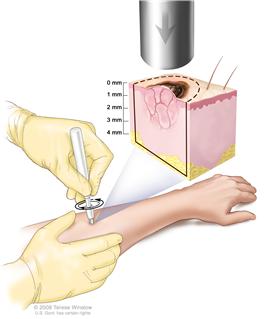 Biopsia con sacabocados; el dibujo muestra un instrumento afilado, hueco, con forma de bolígrafo que se inserta en una lesión de la piel del antebrazo del paciente. El instrumento se gira en el sentido de las agujas del reloj y en sentido contrario a las agujas del reloj para cortar la piel y extraer una muestra pequeña de tejido que se observa bajo un microscopio. La ampliación muestra que el instrumento corta alrededor de 4 milímetros (mm) de grosor hasta llegar a la capa del tejido graso debajo de la dermis.