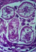 Figure 2. Cross-section of Baylisascaris procyonis larva in tissue section of brain, demonstrating characteristic diagnostic features including prominent lateral alae and excretory columns.