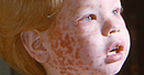 Image of a young boy with rubella, a respiratory viral infection causing low-grade fever and rash lasting about 3 days.