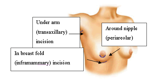 Graphic that shows various incision sites:  Transaxillary or under the arm, inframammary or in the breat fold and periarcolar or around the nipple