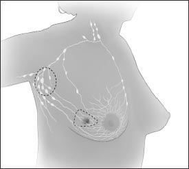 En la cirugía conservadora de seno, el cirujano extirpa el tumor en el seno y algo de tejido de su derredor. Es posible que extirpe algunos de los ganglios linfáticos bajo el brazo. A veces el cirujano extirpa algo del revestimiento que está sobre los músculos del pecho, debajo del tumor.