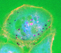 Breast cancer cell with active fingerlike protrusions called invadopodia (pink) that degrade the extracellular matrix (green). Credit: Kevin Branch of the Weaver Lab