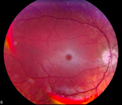 Fundus photograph showing retina changes associated with Tay-Sachs disease.