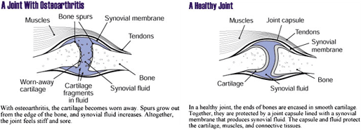 Illustrations of a Joint with Osteoarthritis and a health joint