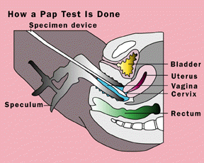 illustration of how a Pap test is done