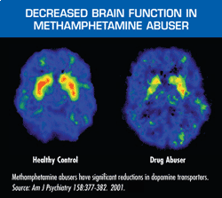 Decreased Brain Function in Methamphetamine Ambuser image