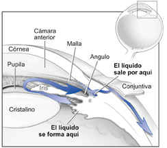 Diagrama de un ojo antes de la cirugía