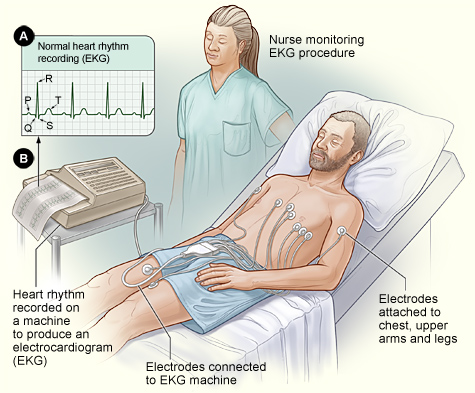 The illustration shows the standard setup for an EKG. In figure A, a normal heart rhythm recording shows the electrical pattern of a regular heartbeat. In figure B, a patient lies in a bed with EKG electrodes attached to his chest, upper arms, and legs. A nurse watches the painless procedure.