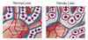 Pericentral fibrosis in alcoholic liver disease