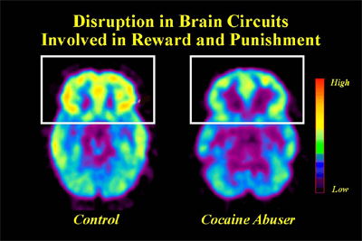 Distruption in Brain Circuits Involved in Reward and Punishment Image