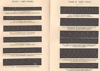 A series of Sphygmograph tracings