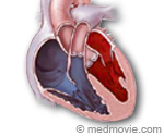 Congestive Heart Failure Illustration