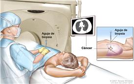 Biopsia de pulmón; el dibujo muestra a un paciente tendido sobre una camilla que se desliza a través de una máquina de tomografía computarizada (TC) y una imagen de una radiografía de un corte transversal del pulmón en un monitor encima del paciente. El dibujo también muestra a un médico usando la imagen radiográfica para ayudarlo a colocar la aguja de biopsia a través de la pared torácica, hasta el área del tejido anormal del pulmón. El dibujo del recuadro muestra una vista lateral de la cavidad torácica y los pulmones, con la aguja de biopsia insertada en el área de tejido anormal.