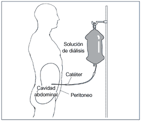 Un diagrama de un paciente recibiendo diálisis peritoneal. Las etiquetas señalan la solución de diálisis, el catéter, el peritoneo y la cavidad abdominal. La solución de diálisis gotea mediante el catéter hacia una bolsa de plástico en la cavidad abdominal.