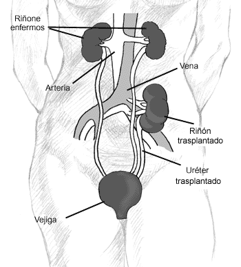 Un diagrama que muestra la localización de un riñón donado en la parte inferior del abdomen. Los riñones enfermos se quedan en la parte superior del abdomen. Las etiquetas señalan a los riñones enfermos, la arteria, la vena, el riñón trasplantado, el uréter trasplantado y la vejiga.