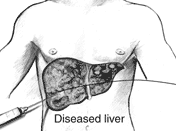 Image of diseased liver from Hepatitis C