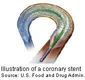 HealthDay news image for article titled: Blood Flow Measurement Boosts Stent Outcomes