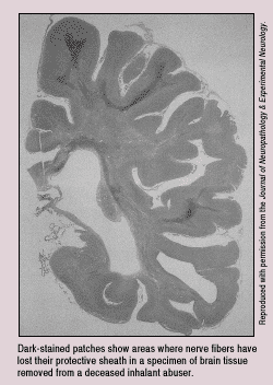 Nerve fiber deterioration in an inhalant abuser