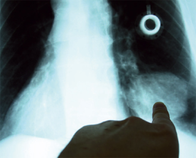 x-ray pinpointing lung cancer
