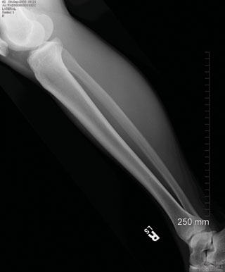 x-ray of a human leg