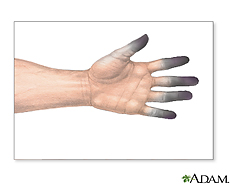 Illustration of frostbite on the fingers