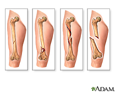 Illustration of fracture types