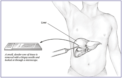 Illustration of a liver biopsy where a biopsy needle is used to remove a small slender or core of tissue which is in turn looked at under a microscope.