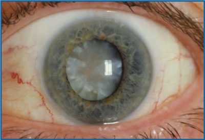 eye with cataract