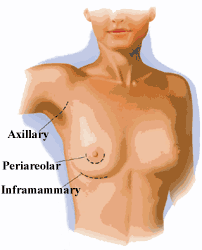 Graphic showing the Axillary, Periareolar and Inframammary Sites