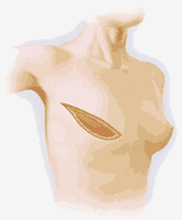 Graphic showing a Mastectony Scar