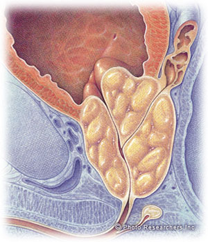 An enlarged prostate gland pushes into the bladder