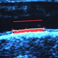 data from carotid artery ultrasound