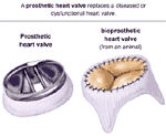 Prosthetic Heart Valve Illustration