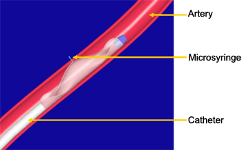 Illustration of catheter carrying microsyringe inside an artery.  The microsyringe extends at a right angle from the catheter into and beyond the wall of the artery.