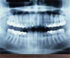 x-ray of teeth