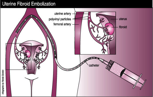 picture showing a fibroid in the uterus, the uterine artery and femoral artery, and how the catheter is inserted.