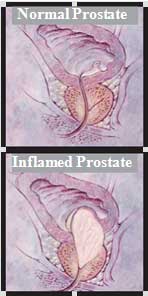 Graphic of a normal and inflamed prostate.