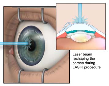 (Still frame of the animation; depicts laser beam reshaping the cornea during LASIK procedure. A textual description of the animation follows below.)