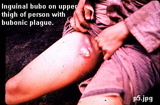 Photograph: Inguinal bubo on upper thigh of person with bubonic plague