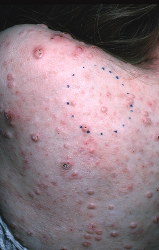 Severe case of molluscum on an immunocompromised patient's back.  The bumps are numerous and many are quite large.