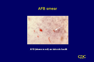 Slide 50: AFB smear. Click for larger version.